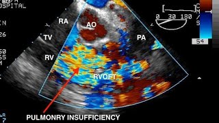 Endocarditis Echocardiography [upl. by Mraz]