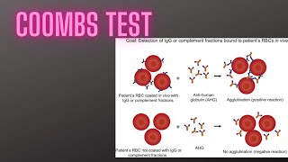 Coombs test or anti human globulin test for differentiating immune hemolytic anemia [upl. by Irrej181]