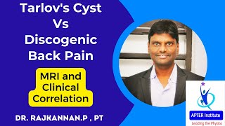 Tarlovs Cyst Vs Discogenic Back Pain [upl. by Lazor993]