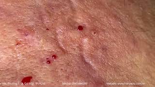 Big Cystic Acne Blackheads Extraction Blackheads amp Milia Whiteheads Removal Pimple Popping [upl. by Ahcsim]