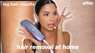 I TRIED LASER HAIR REMOVAL AT HOME this is what happened [upl. by Anaderol128]