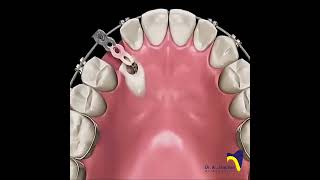 Canine Impaction dentistbracing orthodonticscanineimpactionImpactionExposureCanineexposure [upl. by Einwahs]