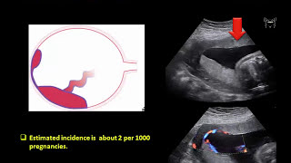 Ultrasound Imaging of the placenta Part 1 Anatomy and Variants [upl. by Cassaundra]