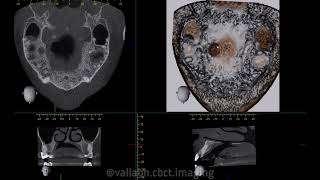 SURGICAL DEFECT as seen in a CBCT scan [upl. by Ahsille74]