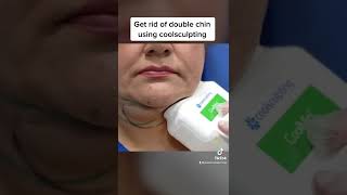 Doublechin removal using coolsculpting shorts [upl. by Golliner657]