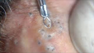 Blackheads Comedones  Behind extraction procedure [upl. by Moyer841]