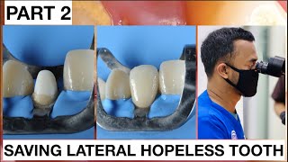 Step by Step Saving Lateral Hopeless Tooth Part 2  General Dentist Griya RR [upl. by Ellehsat]