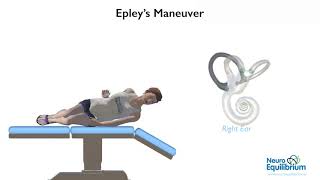 Epley Maneuver A Step by Step Guide to Treat BPPV Vertigo [upl. by Oiled]