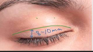 Marking the Upper Eyelid Incision [upl. by Attolrac395]