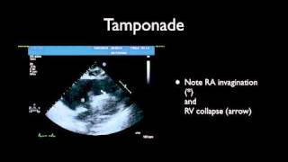 Tamponade amp Pericardiocentesis [upl. by Eralcyram]