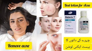 Best Acne Lotion  Dalacin T Lotion  Calindamycin 1 Acne Lotion Review [upl. by Nerek]