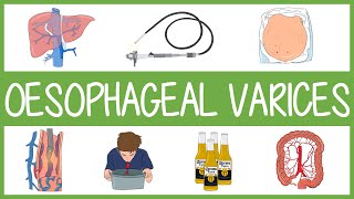 Oesophageal Varices [upl. by Letsou]