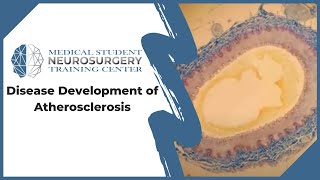 Disease Development of Atherosclerosis [upl. by Ovida675]