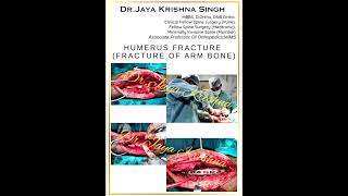 Humerus LCP fracture humerus popular trending orthopedicsurgeon kedarnath [upl. by Eugenie]