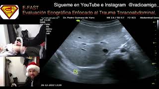 Ecografía E FAST  Simulacro de Evaluación Ecografía en trauma toracoabdominal Pediatria [upl. by Doralynne]