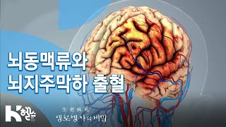 생로병사의 비밀 711회 핫클립👀  quot뇌동맥류quot와 quot뇌지주막하 출혈quot [upl. by Ahouh]