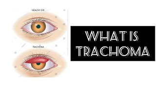 What is Trachoma [upl. by Powder]