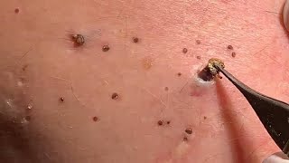 Blackhead removal [upl. by Naarah]