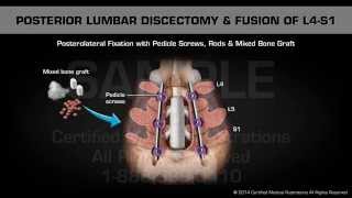 Posterior Lumbar Discectomy amp Fusion of L4S1 [upl. by Selrhc]