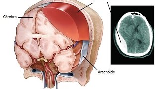 Subdural Hematoma [upl. by Gunilla]