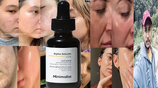 Minimalist Alpha Arbutin 2 Face Serum  Honest Review [upl. by Otineb]