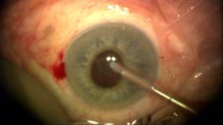 Cataract Surgery in the Severe Flomax Patient [upl. by Fabriane]