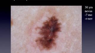 Recurrent nevus or melanoma  Dr Andreas Blum [upl. by Aknayirp]