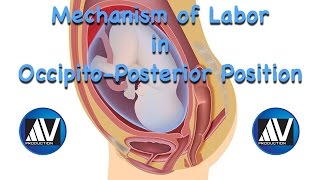 Gynecology Childbirth  Occiput Posterior Position [upl. by Oemor]