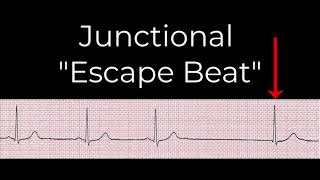 8 Junctional rhythms [upl. by Cassandra]