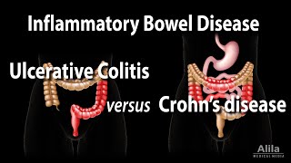 Ulcerative Colitis versus Crohns Disease Animation [upl. by Ruyam]