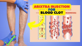 Arixtra Injection for Blood Clot Prevention Common Uses and Benefits [upl. by Dnumyar]