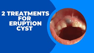 2 Treatments For Eruption Cyst Recommended by Dentists [upl. by Durrell]