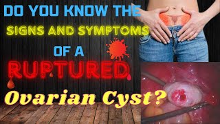 Explained Ruptured ovarian cyst SIGNS and SYMPTOMS [upl. by Anelaf]