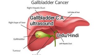 Abdominal ultrasoundCA Gallbladder ultrasound in urdu hindi [upl. by Anaeda]