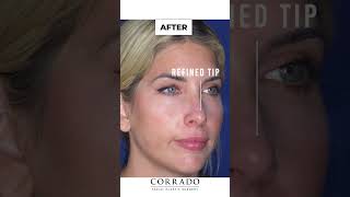 Rhinoplasty Results After 1 Week by NJ Nose Surgeon Dr Anthony Corrado [upl. by Carrel]