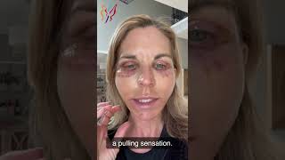 My Advanced Facelift Recovery Day by Day  Real Stories By Real Patients 2022 [upl. by Hahnert894]