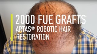 Hair transplant 2000 FUE Grafts ARTAS® Robotic Hair Restoration  Hair By Dr Max [upl. by Kristianson]