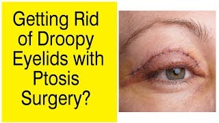 Fix Droopy Eyelids  Ptosis Surgery  The Esthetic Clinics India [upl. by Htiek378]