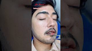 Carbon Peel Laser Treatment getsmarthairclub viralvideo beauty laserhairtreatment laser [upl. by Weisbart]