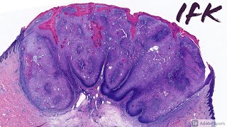 Inverted Follicular Keratosis with AWESOME squamous eddies ‪ Dermatology Dermpath Pathology [upl. by Orfurd9]