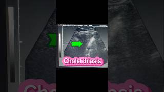 Stones in GB  Cholelithiasis  Cholecystitis  Gallstones  Fatty liver on Ultrasound [upl. by Lebna]