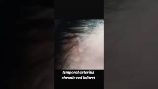 temporal arteritis chronic cerebro vascular disease infarcttuloy ang buhay [upl. by Lemon]