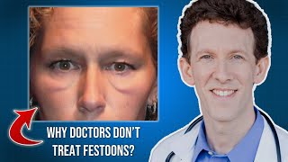 Why Many Doctors Dont Treat Festoons [upl. by Aliehc272]