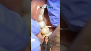 dental hygienist removes difficult piece of calculus shorts [upl. by Olatha18]