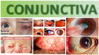 Conjuctiva 3 Major Topic Mucopurulent and Purulent Conjuctivitis [upl. by Yesdnik]