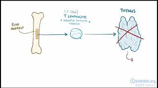 Digeorge Syndrome Osmosis [upl. by Drucie]