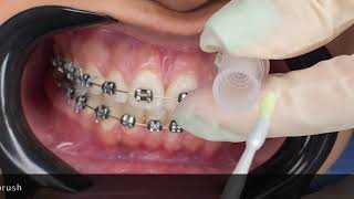 Use of PRG Barrier Coat  Giomer  on orthodontic patient in order to prevent caries development [upl. by Snej]