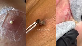 41 Minutes Of Top ASMR Pimple Popping Video [upl. by Brittani635]