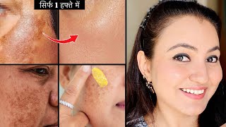 कितनी भी मुश्किल झाइयाँ MELASMA HYPERPIGMENTATION हों  करें 100 इलाज़ सिर्फ 1 हफ्ते में [upl. by Chuu278]