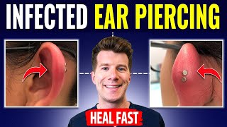 Doctor explains HOW TO RECOGNIZE AND TREAT INFECTED EAR PIERCING [upl. by Yokum]